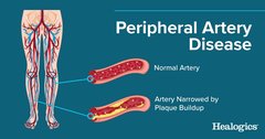 PERIPHERAL ARTERY DISEASE